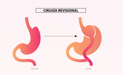 cirugia revisional